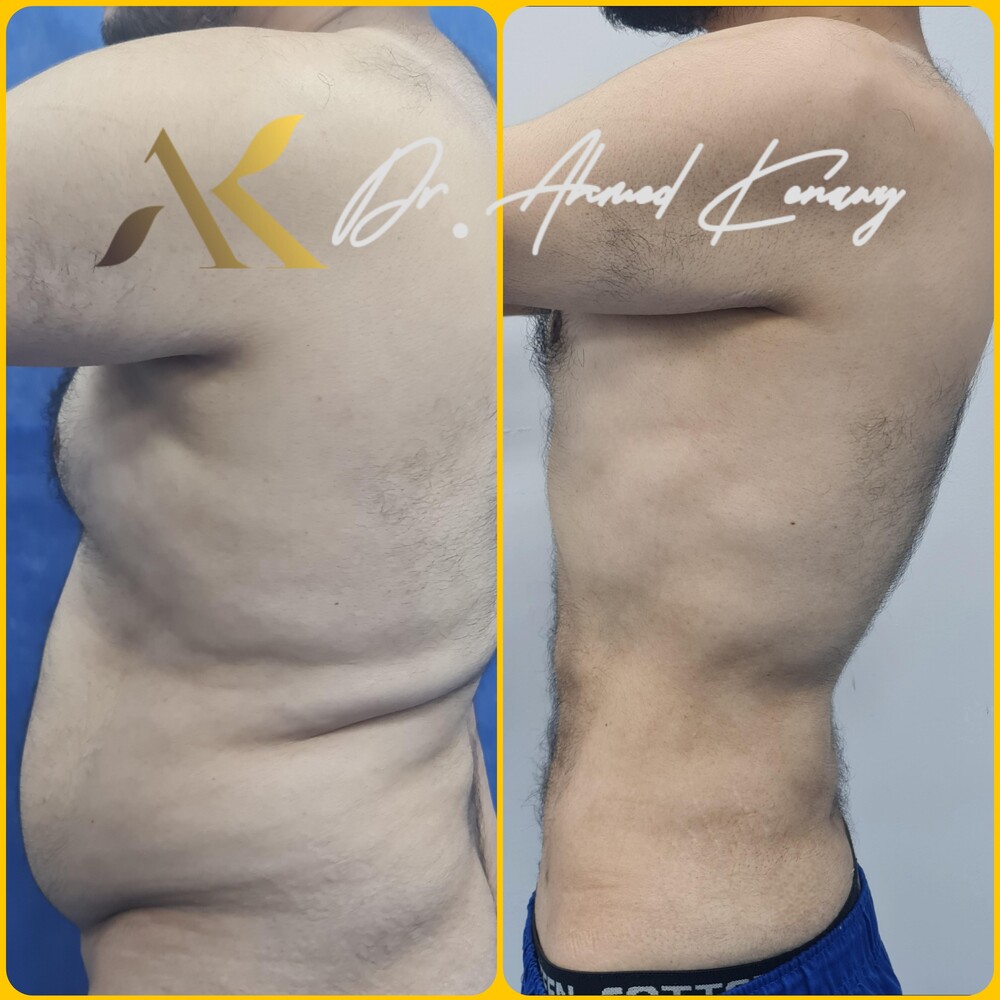 Before and After Result